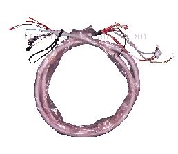 lumenis laser umbilical
